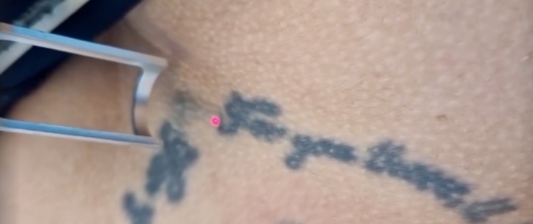 Láser ND YAG- Eliminación de tatuajes